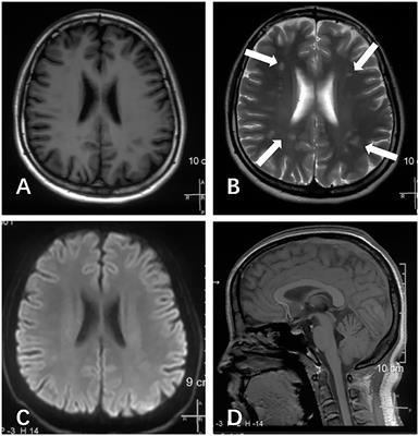 Case Report: A Novel CACNA1A Mutation Caused Flunarizine-Responsive Type 2 Episodic Ataxia and Hemiplegic Migraine With Abnormal MRI of Cerebral White Matter